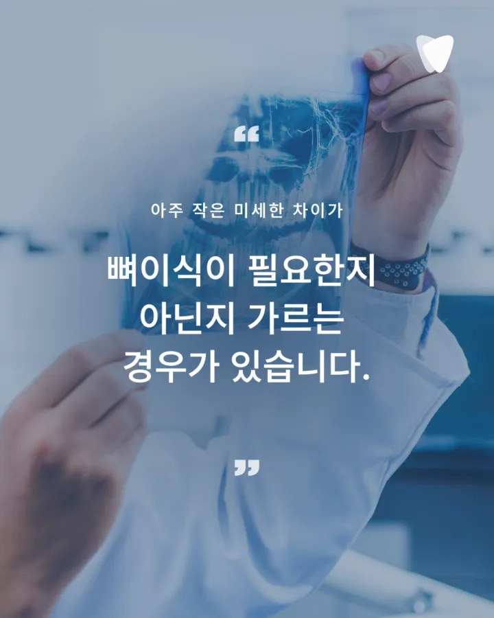 이미지 카드 · 임플란트 전 뼈가 부족하다는 진단, 정말 뼈이식이 꼭 필요할까?