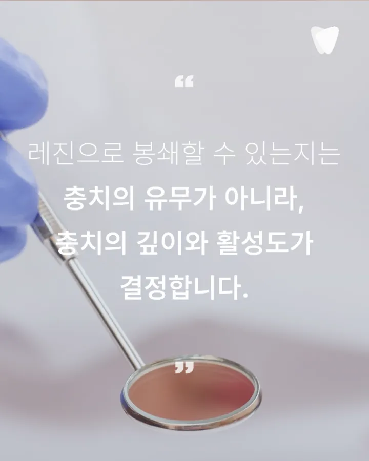 이미지 카드 · 초기 충치 레진 치료, 깎지 않고 지켜볼 수 있는 기준은 무엇인가