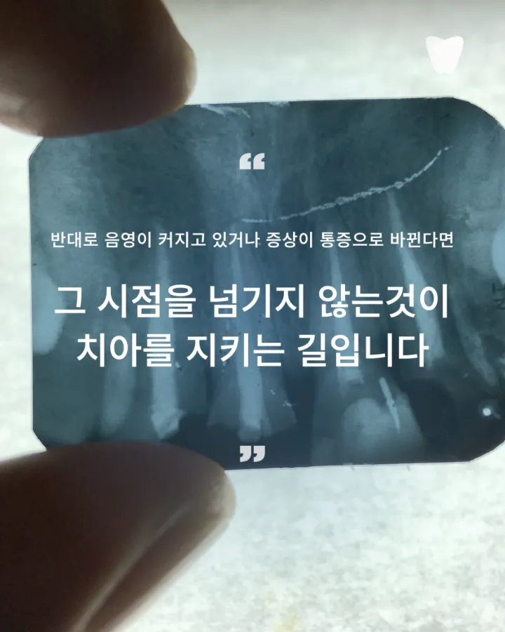 이미지 카드 · 열어야 할까, 두어야 할까 — 재신경치료를 결정하는 판단 앞에서