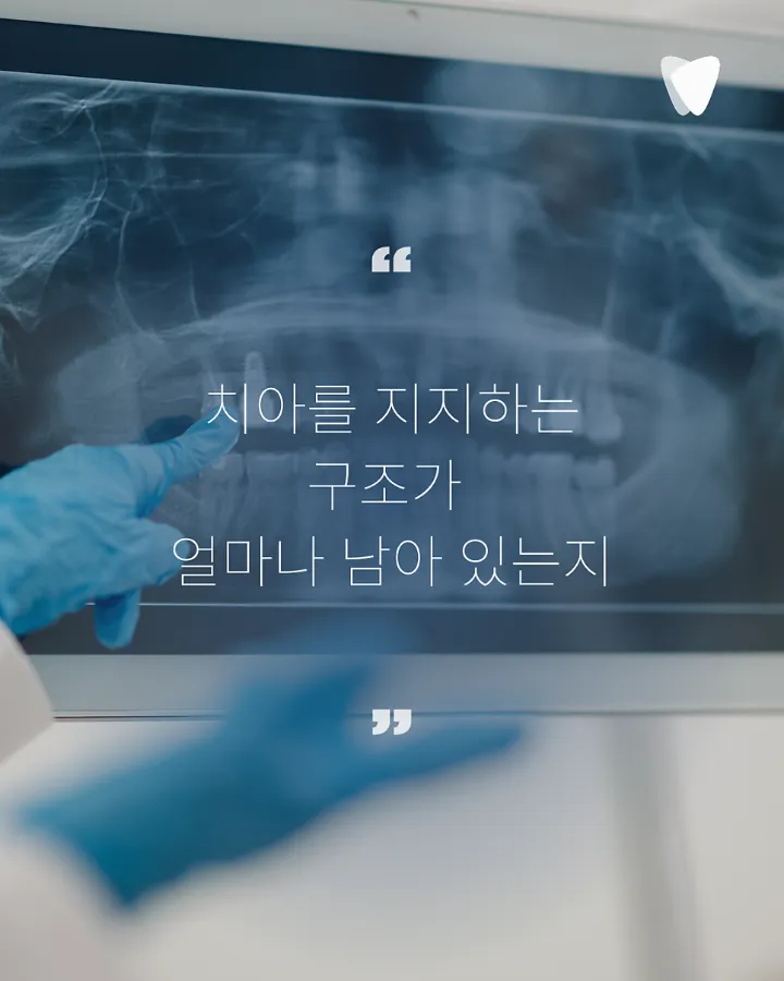 이미지 카드 · 운정 발치 고민 중이라면, 치아를 뽑기 전 한 번 더 확인해야 하는 이유