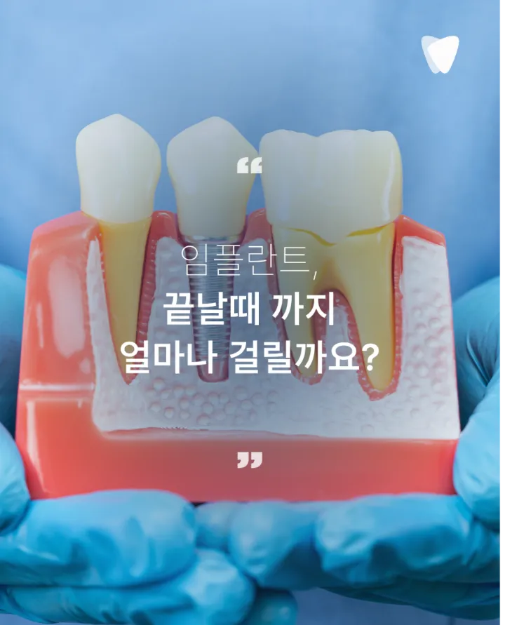 이미지 카드 · 임플란트 기간, 발치부터 보철까지 얼마나 걸릴까요?