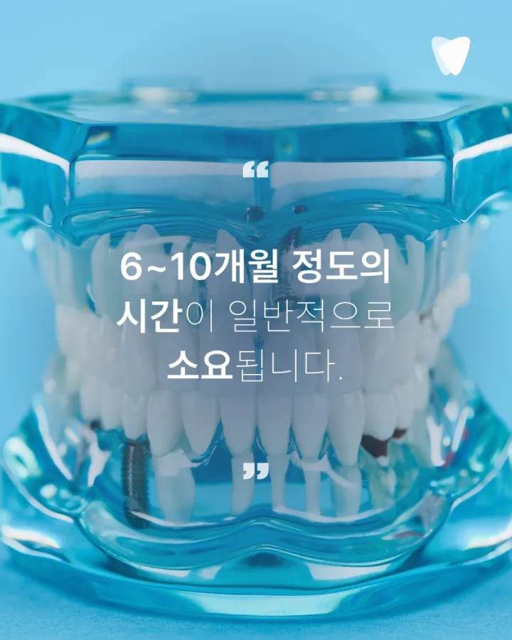 이미지 카드 · 임플란트 기간, 발치부터 보철까지 얼마나 걸릴까요?