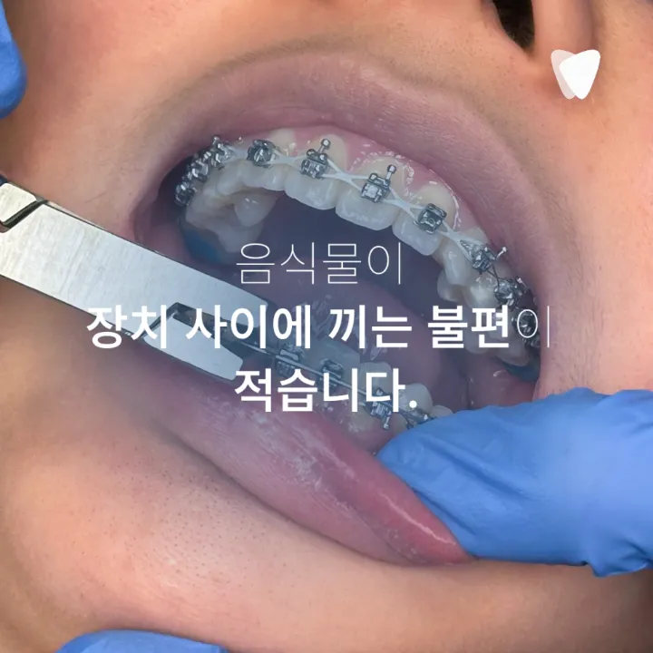 이미지 카드 · 투명교정 - 양치, 충치 관리가 더 쉬운 이유