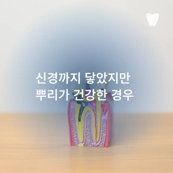 이미지 카드 · 충치가 깊어도 치아를 살릴 수 있는 경우