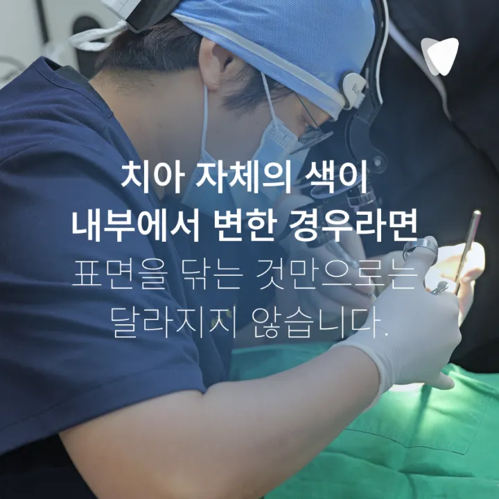 이미지 카드 · 치아의 검은 점은 모두 충치일까요? 착색과 구분하는 방법