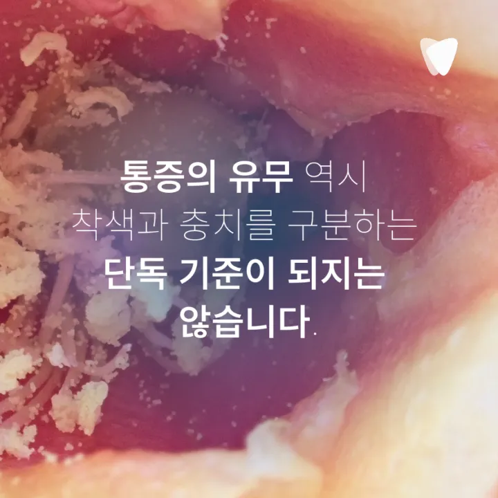 이미지 카드 · 치아의 검은 점은 모두 충치일까요? 착색과 구분하는 방법