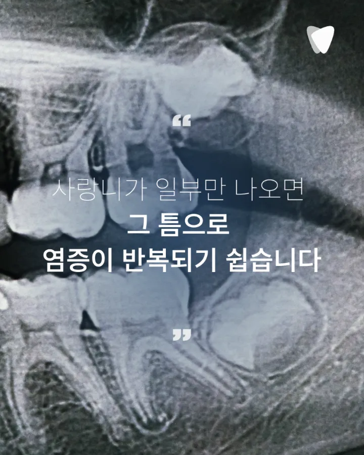 이미지 카드 · 사랑니 주변 잇몸이 붓고 입이 잘 안 벌어지는 이유