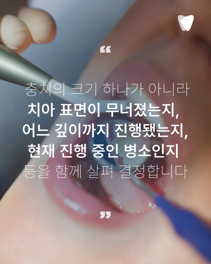 이미지 카드 · 초기 충치, 바로 치료할지 지켜볼지 결정하는 기준