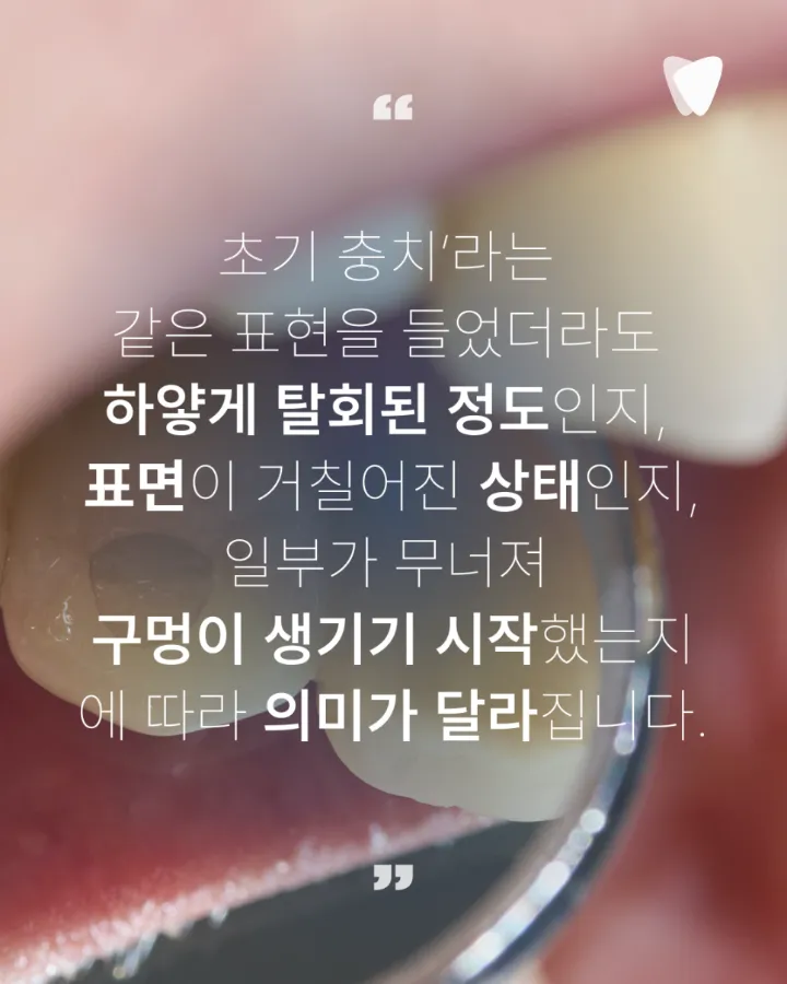 이미지 카드 · 초기 충치, 바로 치료할지 지켜볼지 결정하는 기준