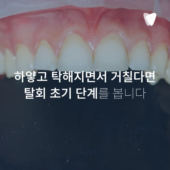 이미지 카드 · 치아 표면이 거칠어진 느낌이 들 때 확인할 것
