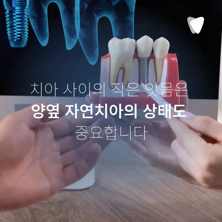 이미지 카드 · 앞니 임플란트, 잇몸 라인까지 봐야 하는 이유