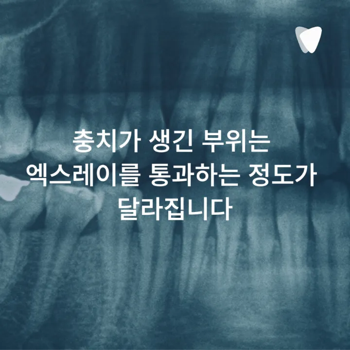 이미지 카드 · 치아 사이 충치는 왜 엑스레이에서 먼저 보일까요?