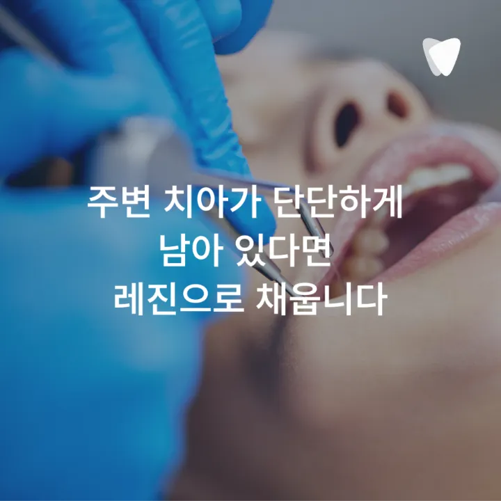 이미지 카드 · 레진·인레이·크라운, 충치 치료 방법이 달라지는 기준