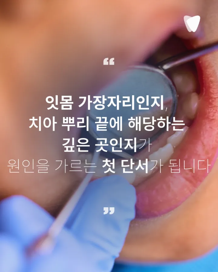 이미지 카드 · 치아와 잇몸 경계를 눌렀을 때 아픈 이유, 뿌리 끝 염증과 치주농양의 차이