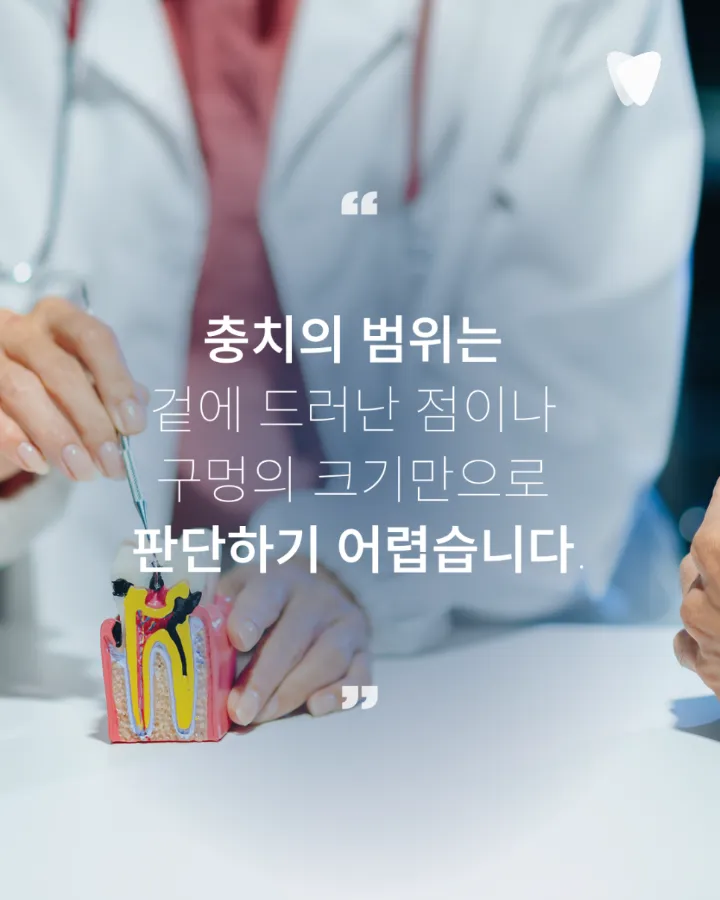 이미지 카드 · 충치는 겉보다 안쪽에서 더 크게 진행될 수 있습니다