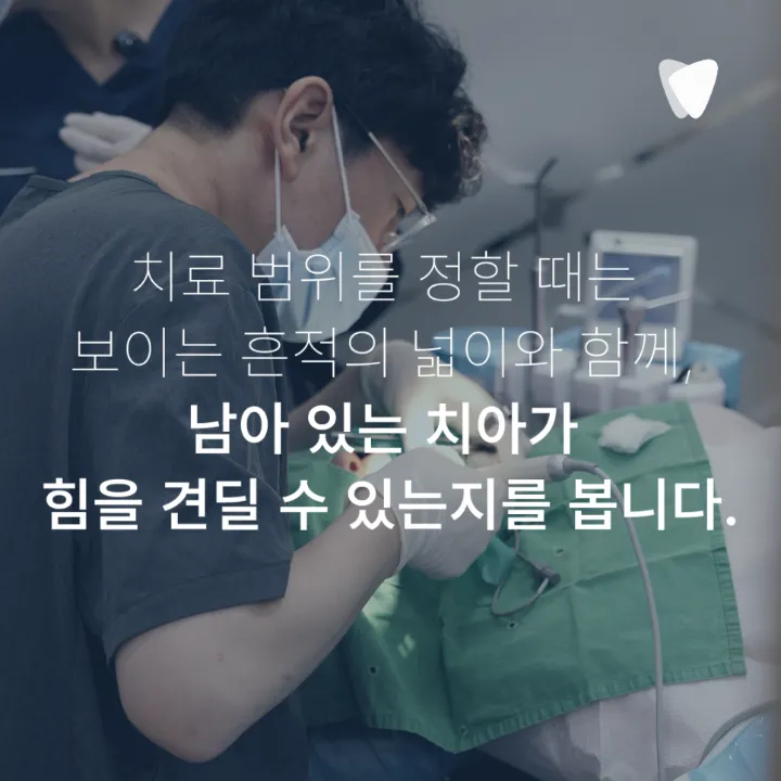 이미지 카드 · 충치는 겉보다 안쪽에서 더 크게 진행될 수 있습니다
