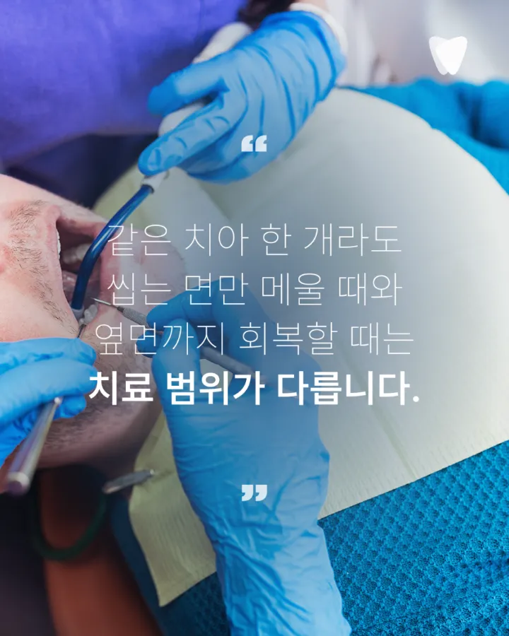 이미지 카드 · 레진 치료 비용이 치아마다 다른 이유: 치료 면·위치·접착 조건