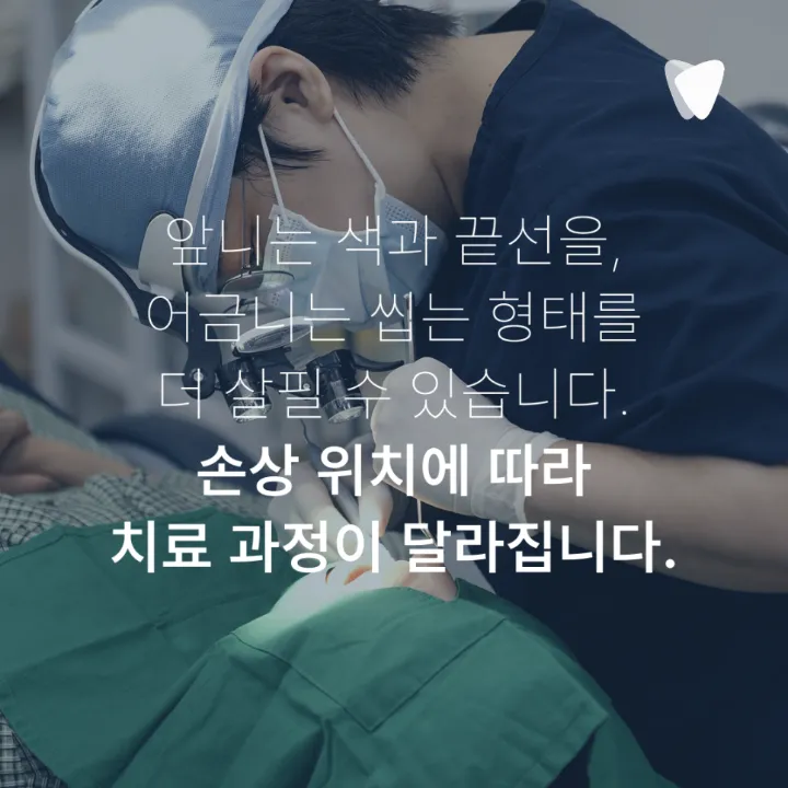 이미지 카드 · 레진 치료 비용이 치아마다 다른 이유: 치료 면·위치·접착 조건