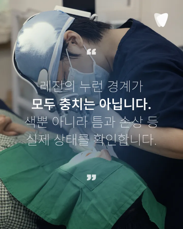 이미지 카드 · 레진 가장자리 변색, 재치료가 필요한 경우와 판단 기준