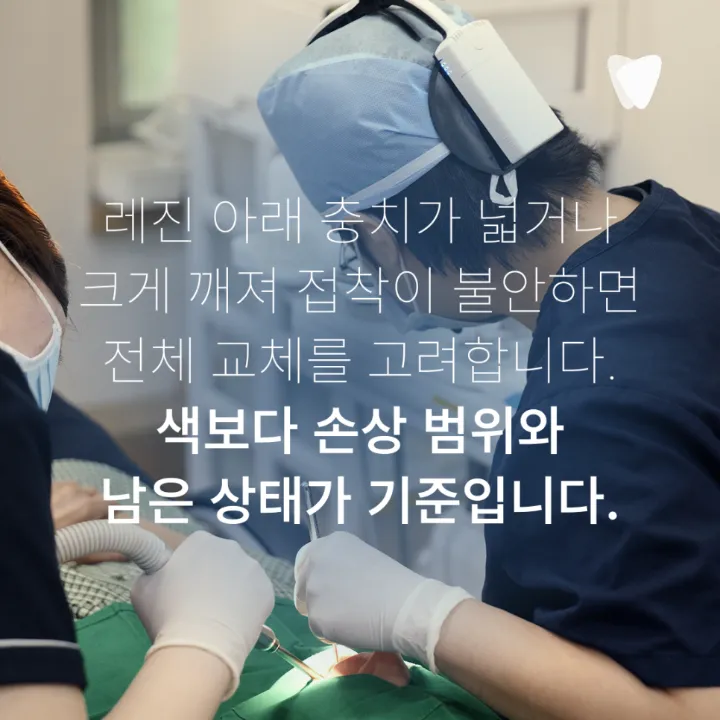 이미지 카드 · 레진 가장자리 변색, 재치료가 필요한 경우와 판단 기준