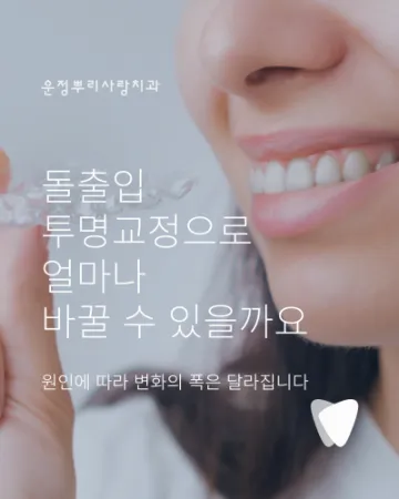 돌출입 때문에 투명교정을 알아보고 계신가요?