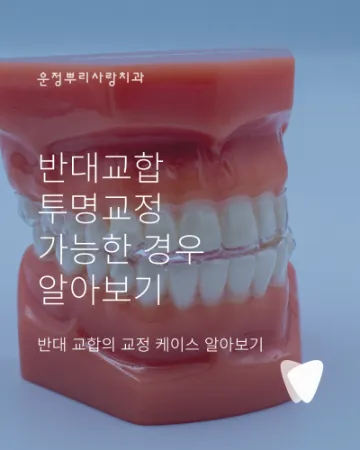 운정 반대교합 투명교정, 가능한 경우는 따로 있습니다