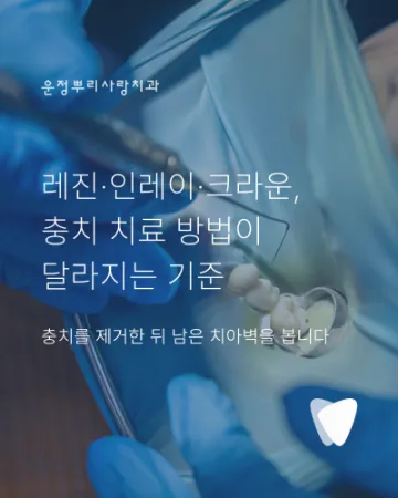 레진·인레이·크라운, 충치 치료 방법이 달라지는 기준