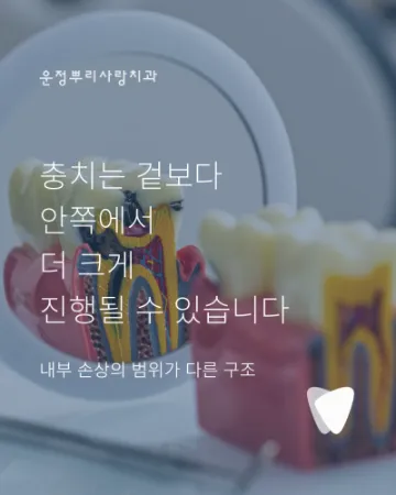 충치는 겉보다 안쪽에서 더 크게 진행될 수 있습니다